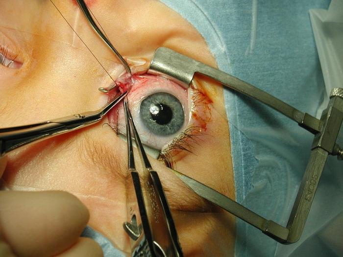Göz ameliyatının ne kadar maliyeti olduğunu öğrendikten sonra, hoş bir sürpriz olacaksınız.